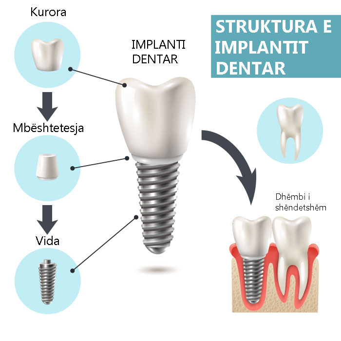 implante dentare