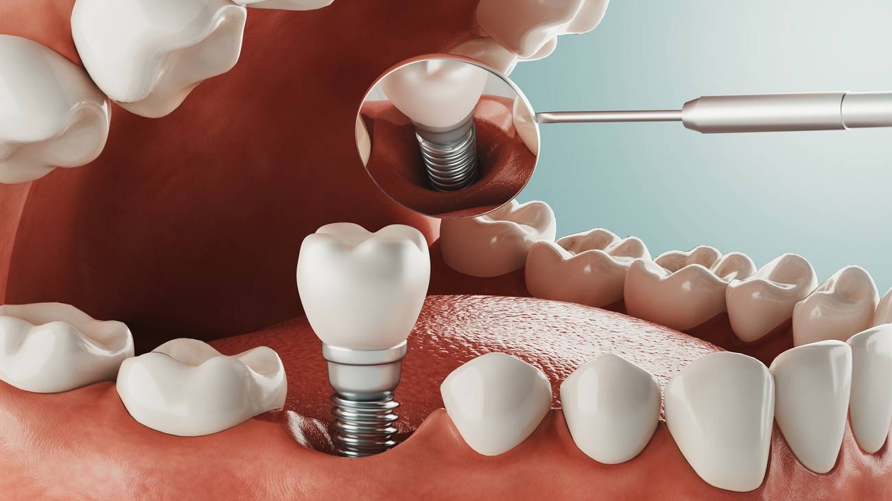 dental-implant-image