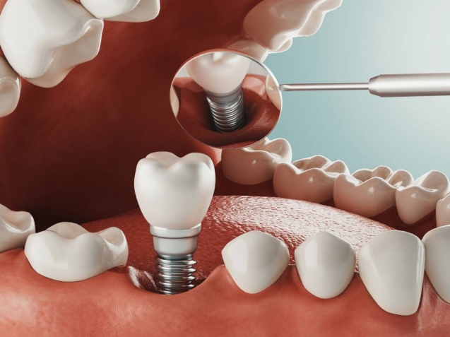 dental-implant-image