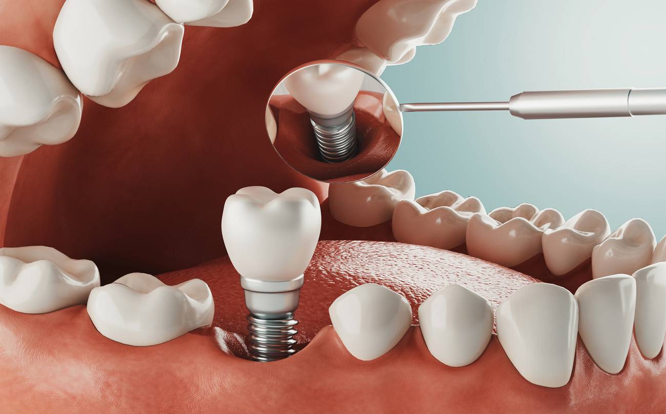 dental-implant-image