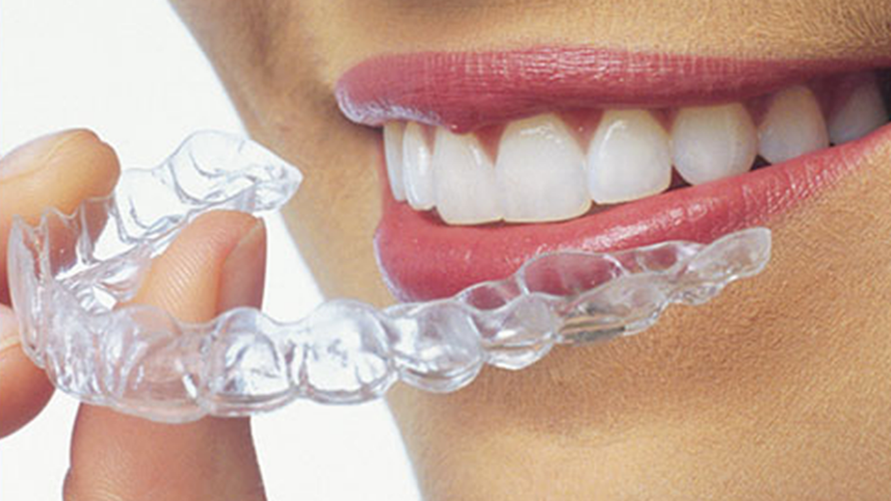 clear_aligners
