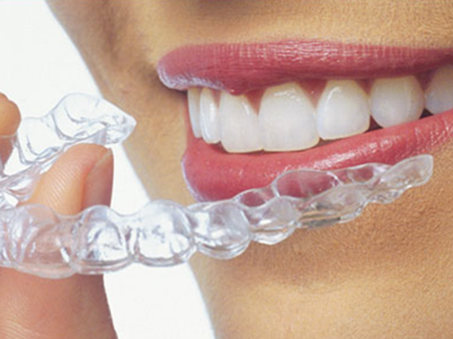 clear_aligners