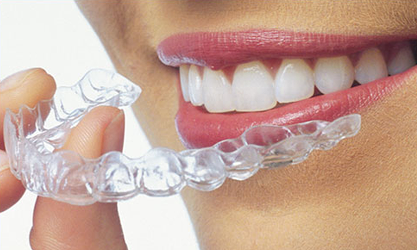 clear_aligners